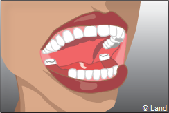 La prothese amovible