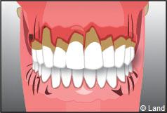 Les maladies des gencives