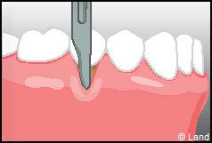 Chirurgie mucogingivale