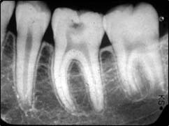 Les maladies des gencives